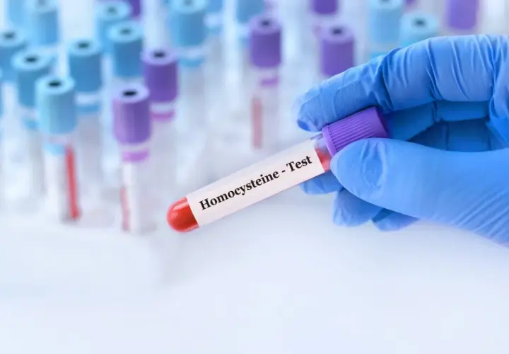 Rękawiczka trzyma probówkę z krwią do badania homocysteiny. Co to jest homocysteina? To aminokwas, którego poziom we krwi jest ważny dla zdrowia.