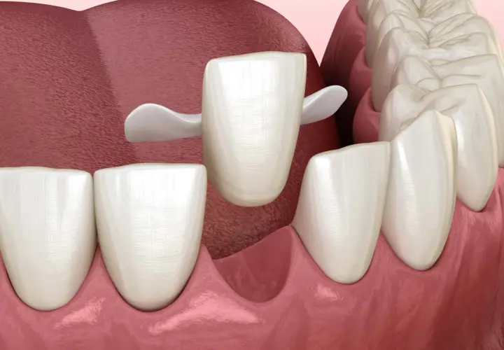 Una corona dentale bianca si posiziona su un dente preparato, pronta a proteggere un dente che si stacca.