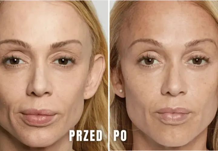 Ile kwasu hialuronowego dziennie? Sprawdź, aby uniknąć błędów