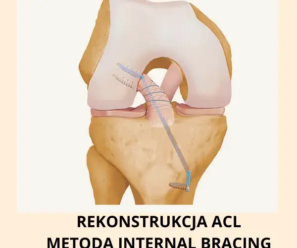 Rekonstrukcja ACL prywatnie czy na NFZ – co wybrać, by uniknąć błędów i kosztów?