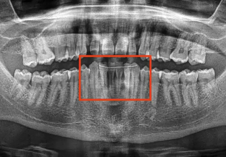 Radiografia panoramica dei denti con un filo metallico che stabilizza i denti anteriori. Un dente che si muove si può salvare con cure adeguate.