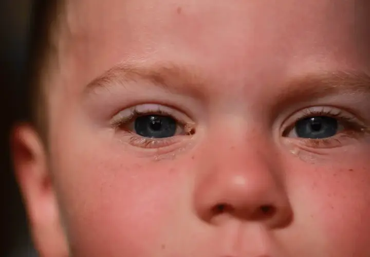 Ojos de niño con secreción, sugiriendo la necesidad de gotas para conjuntivitis en niños.