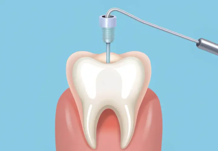 Ilustracja przedstawia narzędzie dentystyczne w zębie, symbolizujące potencjalne objawy stanu zapalnego po leczeniu kanałowym.