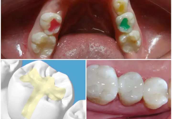 Sigillatura molari bambini: pro e contro. Denti con sigillante colorato e modello 3D di applicazione.