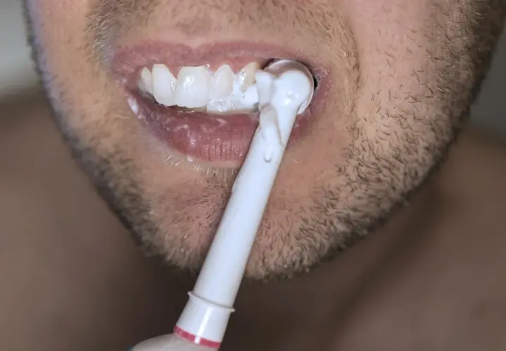 Bocca con denti bianchi e spazzolino elettrico. Nonostante la cura, la carie è una preoccupazione.