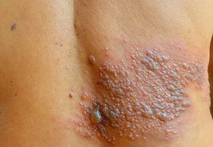 Eruzione cutanea con vescicole, simile al fuoco di Sant'Antonio, su un fianco. Non è comune nei bambini, ma può verificarsi.