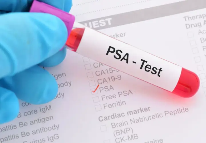 Rękawiczka w niebieskiej rękawiczce trzyma probówkę z napisem "PSA - Test". Zaznaczono pole PSA na formularzu.