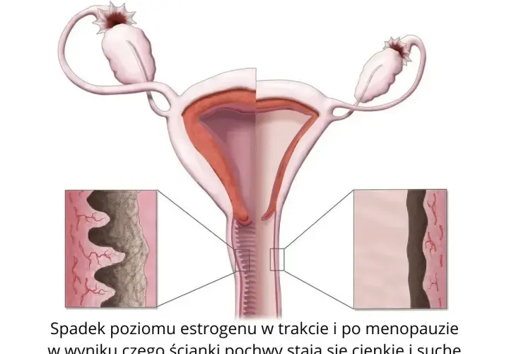 Ilustracja pokazuje zmiany w pochwie podczas menopauzy, prowadzące do suchości pochwy.