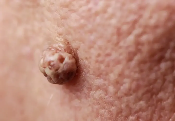 Gros plan d'un acrochordon douloureux sur la peau, texture rugueuse et irrégulière.