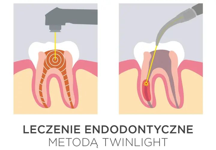 Ilustracja pokazuje laserowe leczenie zębów. Dwa schematy przedstawiają zastosowanie lasera w leczeniu kanałowym, podkreślając jego precyzję i skuteczność.