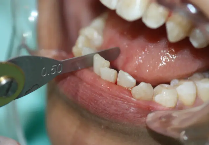 Herramienta dental mide 0.50mm para limar dientes, parte del proceso de tratamiento con Invisalign.