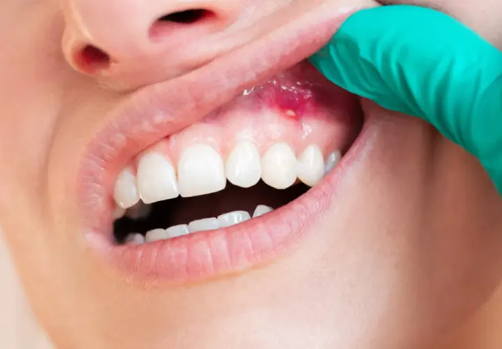 Gingivitis, zapalenie dziąseł. Periodontolog czym się zajmuje? Leczeniem chorób przyzębia, w tym zapalenia dziąseł.