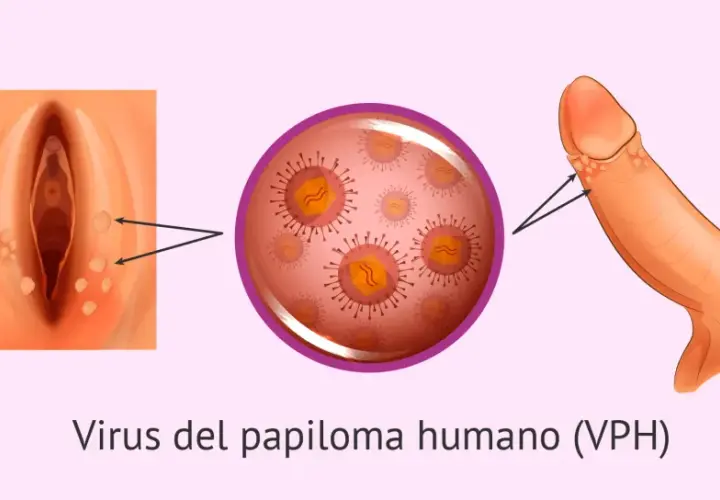 Síntomas del papiloma humano en mujeres: lo que debes saber para actuar