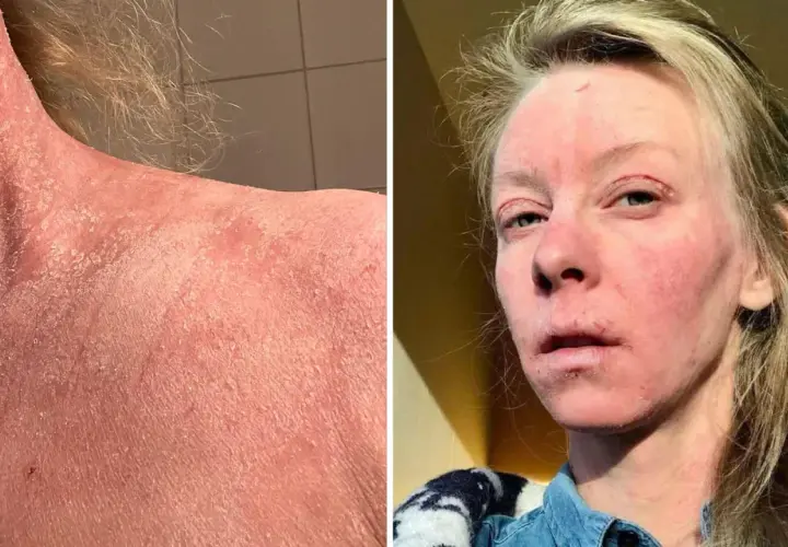 Bilden visar en person med svår hudirritation och fjällning på halsen och ansiktet, möjligen som en reaktion på thiamidol biverkningar.