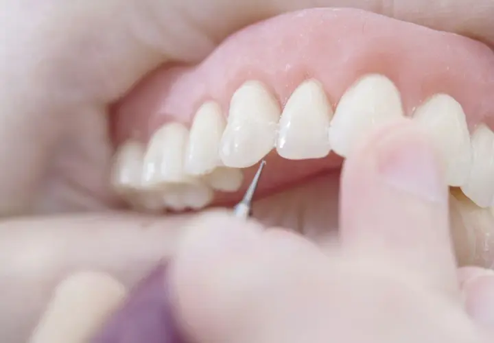 Dettaglio di una dentiera che viene posizionata, un passo importante per abituarsi alla dentiera e ritrovare un sorriso smagliante.