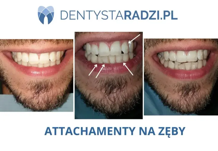 Przed i po: czy nakładki na zęby działają? Widoczne zbliżenie na uśmiech mężczyzny z widocznymi nierównościami, a następnie z nałożonymi przezroczystymi nakładkami.
