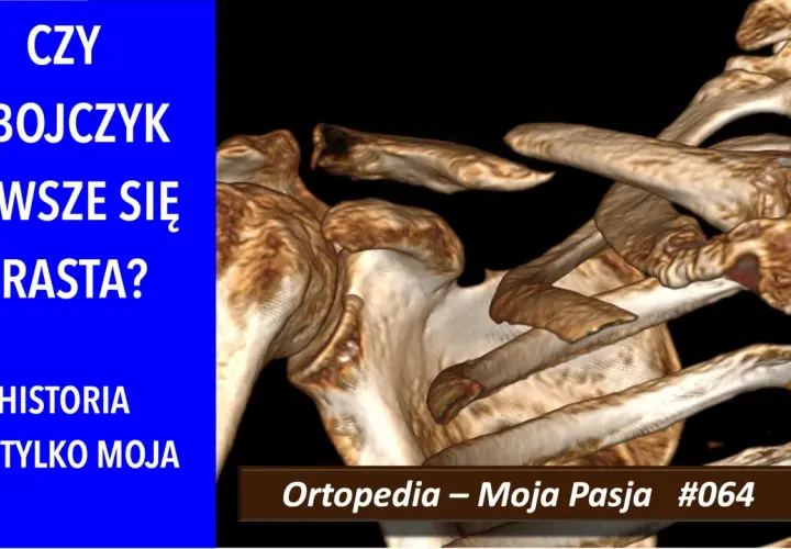 Trójwymiarowy obraz obojczyka, który pokazuje, ile zrasta się kość po urazie. "Ortopedia – Moja Pasja #064".