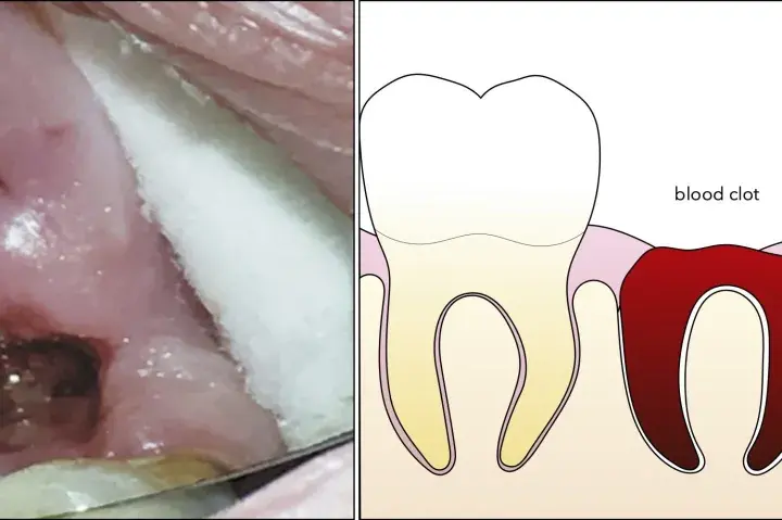 Comparación de un diente con coágulo sanguíneo y alveolitis seca, mostrando los síntomas de alveolitis seca.