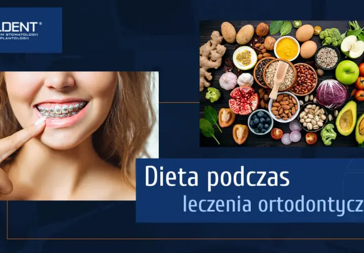 Dieta z aparatem ortodontycznym: Co jeść, by uniknąć bólu i awarii?