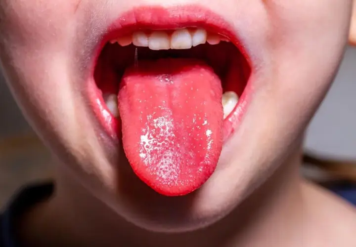 Bocca di bambino con lingua rossa e un po' bianca, possibile sintomo di streptococco.