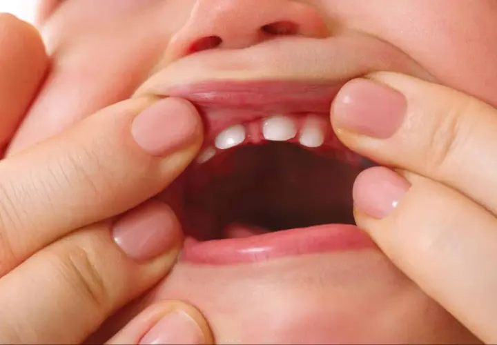 Bebé con frenillo labial inferior inflamado, mostrando sus pequeños dientes.
