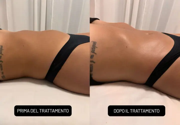 Confronto prima e dopo un massaggio rassodante: la pelle appare più tonica e liscia.