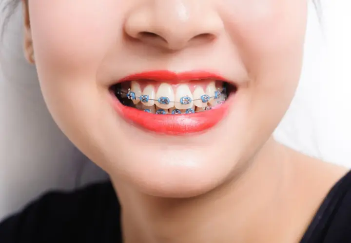 Sonrisa con brackets azules. A veces, los ataches me hacen heridas, pero la sonrisa vale la pena.