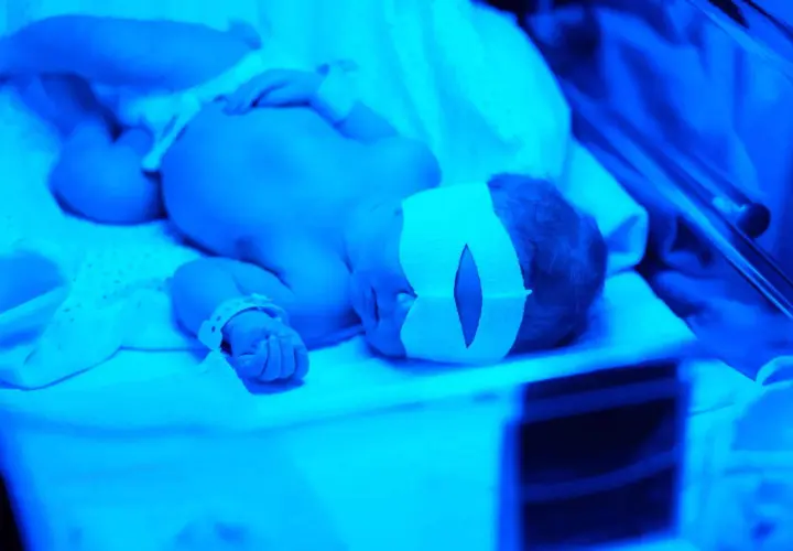Noworodek pod lampami leczącymi żółtaczkę. Ma opaskę na oczach, aby chronić je przed światłem.
