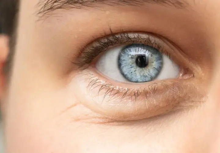 Ojo azul con ojeras hinchadas y finas arrugas bajo el párpado inferior.