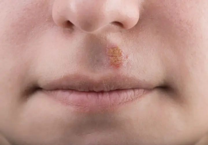 Herpes mento: lesione cutanea con crosticine giallastre e arrossate sul labbro superiore, vicino al naso.
