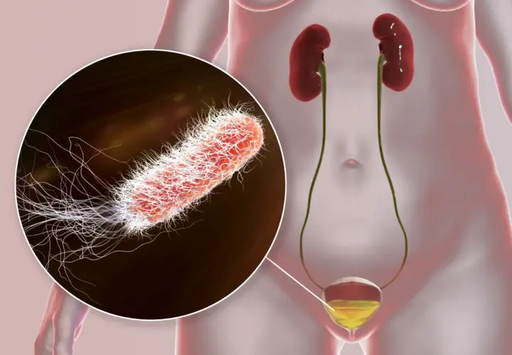 Gros plan sur un germe responsable d'une infection urinaire, montrant sa structure filamenteuse. Le système urinaire humain est également représenté.