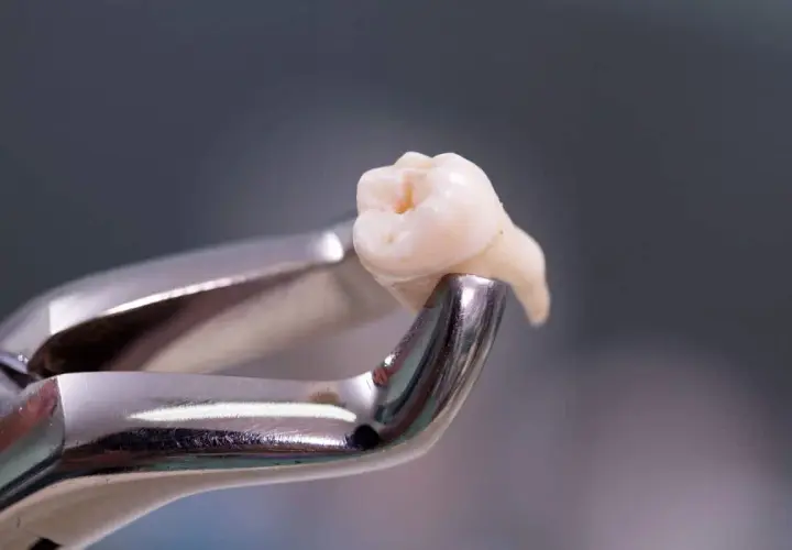 Pinzas dentales sujetan un diente extraído, resultado de una exodoncia dental.