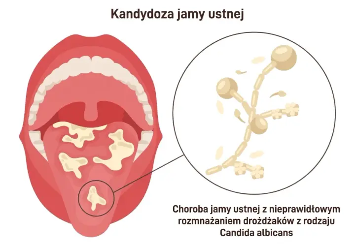 Ilustracja przedstawia jamę ustną z białymi nalotami na języku i podniebieniu, wskazującymi na grzybicę jamy ustnej. Obok powiększony obraz drożdżaków Candida albicans.