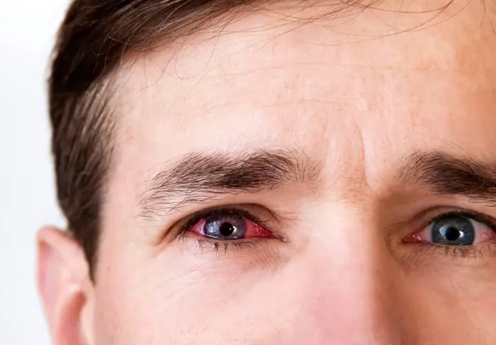 Gros plan sur les yeux d'un homme, l'un d'eux est rouge et irrité, présentant des symptômes de conjonctivite.