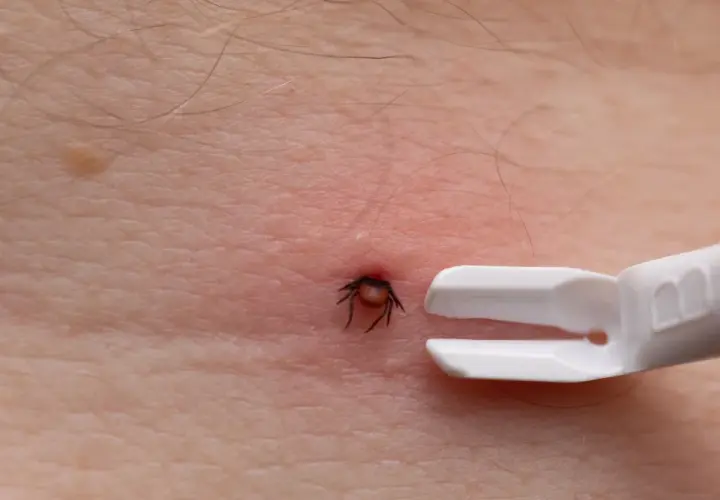Zbliżenie na ludzką skórę z czerwonym zaczerwienieniem wokół wbitego kleszcza. Obok narzędzie do usuwania kleszczy.