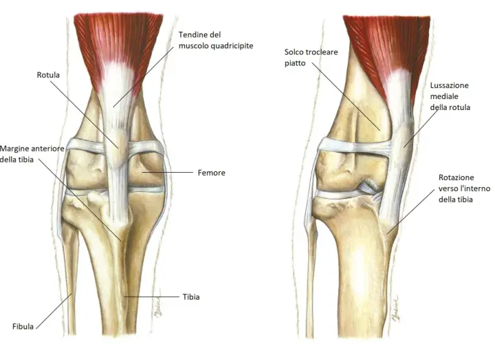 Illustrazione anatomica del ginocchio di un cane, che mostra la rotula e il femore. A destra, la lussazione mediale della rotula, una condizione che può richiedere un intervento chirurgico. Il costo dell'intervento per la lussazione rotula cane varia.