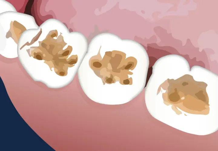 Denti con cavità interne, una carie interna non visibile che distrugge la struttura dall'interno.