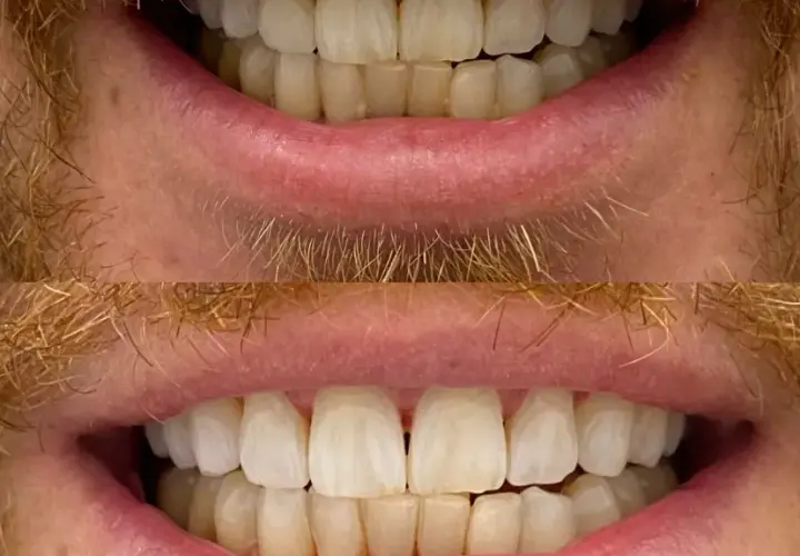 Wybielanie zębów u dentysty: efekty, koszty czy warto?