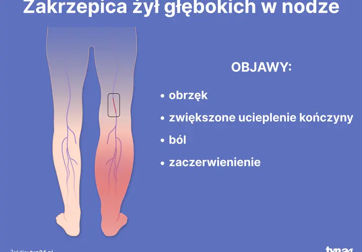 Objawy zaburzeń krzepnięcia krwi: Krwotok czy zakrzep? Sprawdź!