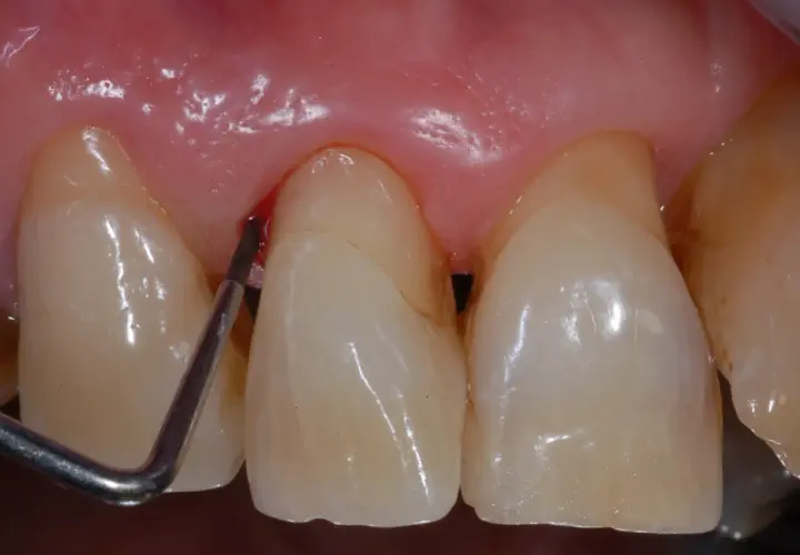 Strumento dentale che causa sanguinamento gengive vicino a un dente.