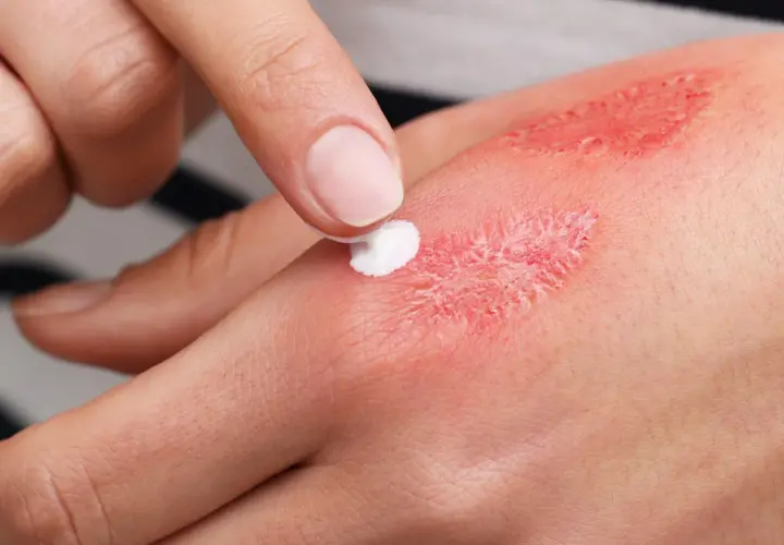 Application de crème sur une brûlure, montrant une rougeur autour de la blessure.