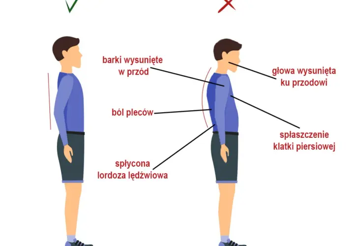 Ilustracja pokazuje prawidłową i nieprawidłową postawę. Nieprawidłowa postawa, z wysuniętymi barkami i głową, spłaszczoną klatką piersiową i płaską lordozą lędźwiową, może być objawem zesztywniającego zapalenia stawów kręgosłupa.