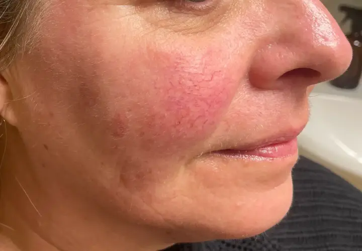 Närbild på en kvinnas kind med synliga röda blodkärl, ett vanligt tecken på rosacea. Fokuserar på hudvård för att hantera tillståndet.