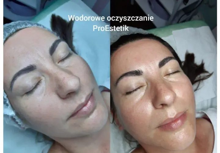 Przed i po zabiegu wodorowym na twarz. Skóra po oczyszczaniu jest promienna i nawilżona.