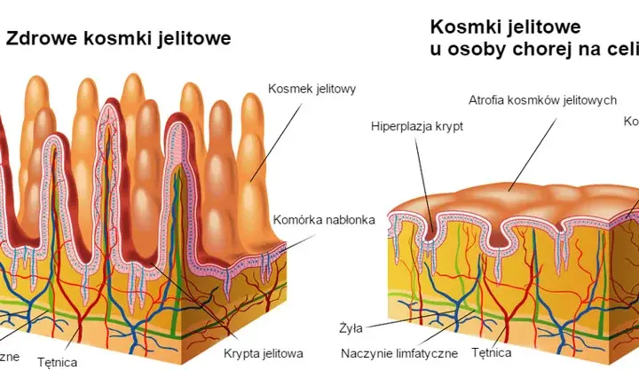 Zanik kosmków jelitowych: 5 faktów o których musisz wiedzieć