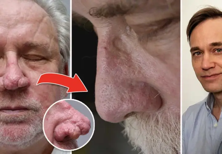 Före- och efterbilder som visar en mans näsa med rhinophyma och en läkare. Möjlig rhinophyma behandling.