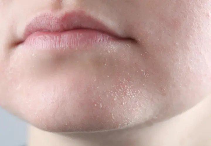 Gros plan sur des lèvres et un menton montrant une peau sèche et squameuse, signe potentiel d'une cause de peau sèche.