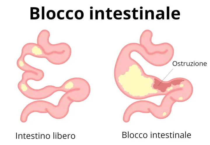 Illustrazione di un intestino libero e di un blocco intestinale, che spiega perché non riesco ad andare in bagno.