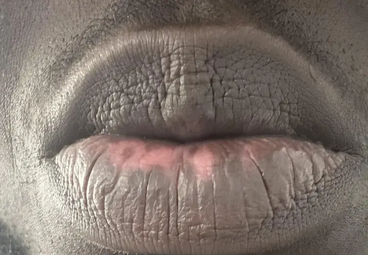 Labios agrietados y con manchas, evidencia de manchas en los labios por fumar.