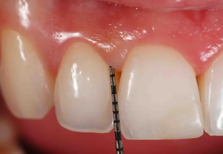 Sonda periodontal mide la profundidad de la encía. La piorrea se pega si no se cuida.
